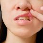 Kerap Menganggu Saat Makan, Ini 9 Cara Menyembuhkan Sariawan