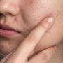 5 Cara Mengatasi Jerawat Meradang, Pengobatan Rumahan Ini Bisa Membantu