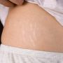 Bukan dengan Scrub, Ini 3 Perawatan Ampuh untuk Menghilangkan Stretch Mark