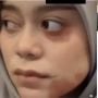 Viral Wajah Lesti Kejora Babak Belur Dipukuli Rizky Billar, Begini Faktanya