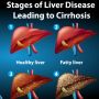 Minuman yang Disukai Banyak Pria Ini Ternyata Bisa Merusak Liver, Lho!