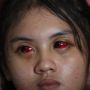 Berapa Lama Mata Merah yang Dialami Korban Tragedi Kanjuruhan Bisa Hilang?