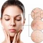 Kenali Tipe Kulit, Sebelum Memilih Skincare Agar Tidak Salah Beli!