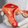5 Mitos Penyakit Endometriosis yang Dipercaya Wanita, Banyak yang Tertipu!