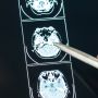 Mengenal Cerebral Atrophy, Penyakit yang Menyebabkan Ukuran Otak Mengecil