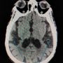 Ketahui Gejala dan Faktor Penyebab Cerebral Atrophy, Terutama pada Anak!