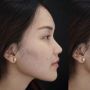 Simak 9 Potret Transformasi Ayu Ting Ting Sebelum dan Sesudah Permak Hidung