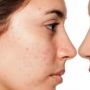 8 Fakta Tentang Jerawat yang Perlu Kalian Sadari, Jangan Percaya Mitos!