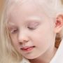 13 Juni Diperingati Sebagai Hari Peduli Albino Sedunia, Apa Itu Albino?