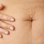 5 Tips Ampuh Menyamarkan Stretch Mark Secara Alami, Yuk Coba!