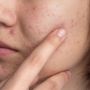 4 Rekomendasi Produk Skincare Viva, Terbaik Atasi Wajah Breakout