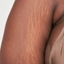Siapa Bilang Stretch Mark Gak Bisa Hilang? Coba Lakukan 5 Tips Alami Ini