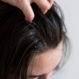 Jangan Keliru, Ini Perbedaan Ketombe dan Psoriasis yang Perlu Kamu Tahu