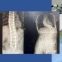 Saraf Kejepit dan Skoliosis Dapat Ditangani dengan Teknologi Robot, Ini Penjelasan Dokter Spesialis Rizki Gatam