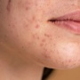 Deretan Kandungan Skincare yang Aman dan Efektif Atasi Bruntusan Kulit Wajah