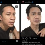 Aming Alami Autoimun, Wajahnya Muncul Bentol Besar
