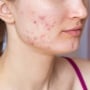 7 Tanda Serum Tidak Cocok di Kulit Wajah, Hentikan sebelum Makin Merusak Skin Barrier