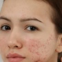 3 Rekomendasi Calming Serum untuk Kulit Sensitif dan Iritasi