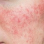 Kulit Wajah Kemerahan Pakai Skincare Apa? Atasi dengan 7 Kandungan Ini