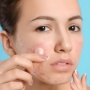 Cara Cerdas Pakai Acne Patch Menurut Dokter, Biar Tak Iritasi dan Over Eksfoliasi