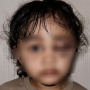 Viral! Anak Selebgram Emy Aghnia Dianiaya Suster hingga Wajah Penuh Lebam