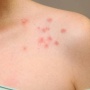 Jarang Diketahui, Ini 3 Penyebab Penularan Herpes yang Sering Diabaikan