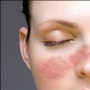 Mengapa Lupus Lebih Banyak Menyerang Wanita?