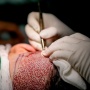 Pendarahan Akibat Transplantasi Rambut, Seorang Pria Ditangkap Karena Dianggap Mengganggu Penerbangan di Miami