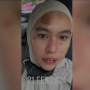 Apa Itu Stevens-Johnson Syndrome? Ini Penyebab Penyakit Berbahaya yang Diderita Kartika Putri