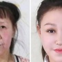 Terlahir Seperti Nenek-nenek, Gadis Ini Akhirnya Temukan Harapan Baru Usai Operasi Plastik