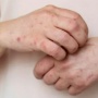 Darurat Global dan Sudah Masuk Indonesia, Apa Saja Gejala Monkeypox?