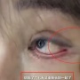 Ngeri! Bola Mata Wanita Ini Ikut Terjahit saat Operasi Kelopak Mata Ganda, Begini Kondisinya