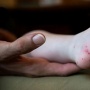 Cara Ampuh Rawat Pasien Flu Singapura di Rumah, Cepat Cegah Penularan!