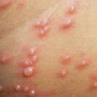 9 Cara Agar Cacar Air Tidak Bertambah Banyak, Diantaranya Mandi Dengan Bahan Ini