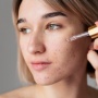 3 Serum yang Mengandung Tranexamic Acid, Ampuh Pudarkan Bekas Jerawat Membandel