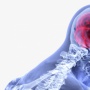 Revolusi Diagnosis Stroke: Teknologi DSA Ungkap Detail Pembuluh Darah Otak!