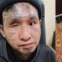 Beda Nasib dengan Agus Salim, Icang Korban Congkel Mata Akhirnya Operasi