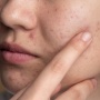 7 Serum Vitamin C untuk Menghilangkan Bekas Jerawat Kehitaman bagi Remaja