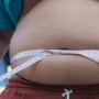 Waspada! Obesitas Tingkatkan Risiko Kanker pada Anak, Ini Penjelasan Ahli