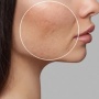 7 Rekomendasi Produk Skincare Yang Bantu Atasi Bopeng di Wajah
