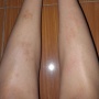 Cara Ampuh Hilangkan Bekas Luka Hitam di Tangan dan Kaki, Ini Kombinasi Skincare-nya