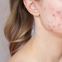 5 Rekomendasi Skincare Penghilang Bopeng di Wajah, Mulai Rp50 Ribuan Kulit Bisa Mulus