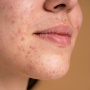 Ciri-ciri Skin Barrier Rusak Menurut dr. Tompi, Bisa Diperbaiki dengan 5 Cara Ini