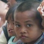Anak dengan Bibir Sumbing Perlu Operasi dan Terapi Sejak Dini, Ini Penjelasan Dokter