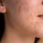 5 Rekomendasi Acne Spot untuk Mengempeskan dan Mengeringkan Jerawat, Mulai Rp19 Ribuan