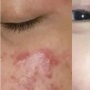 7 Cara Ampuh Atasi Jerawat dengan Produk dan Perawatan yang Tepat, Ini Rekomendasinya!