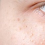 5 Rekomendasi Exfoliating Toner untuk Milia: Hemat dan Aman, Jadikan Kulit Mulus Kembali