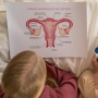 Menstruasi Tidak Teratur? Ini Tanda PCOS yang Perempuan Wajib Kenali!