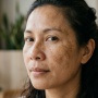 Melasma Tak Sama dengan Flek Biasa, Kenali Pemicunya yang Ternyata Bukan Hanya Sinar Matahari