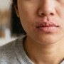 Apa Penyebab Kulit Kering di Sekitar Mulut? Begini Cara Mengatasinya